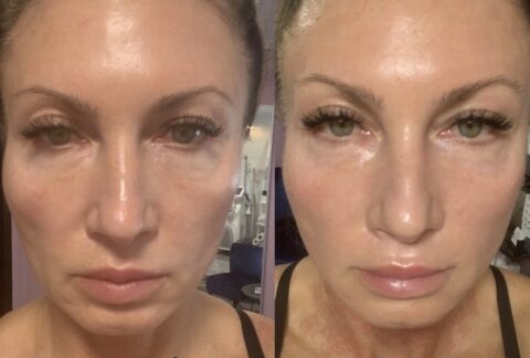 Skin Biorevitalizing behandling